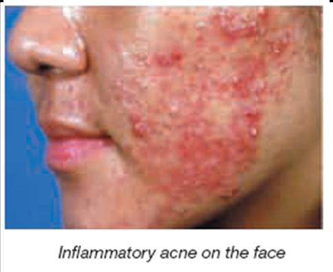 Acne vulgaris (Pimples)