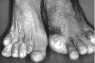Ischaemic foot ulcers and Diabetic Mellitus