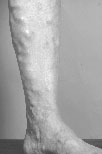 Varicose veins shown on the lower leg