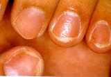 Skin Diseases affecting Nails