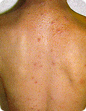 Folliculitis -<br/> infection of the hair pores