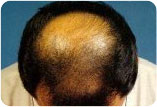 Androgenetic Alopecia in men