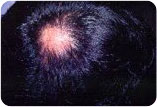 Hair thining in a woman from Androgenetic Alopecia