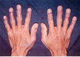Allergic dermatitis from cement