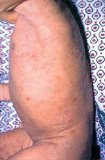 Scabies affecting the trunk