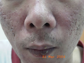 Seborrhoeic dermatitis of the face
