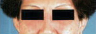 Eyelid Contact Dermatitis