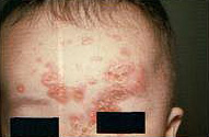 Bacterial Skin Infection (Impetigo or Conjunctivitis)