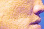 Facial acne scars
