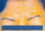 Frown lines at the brow horizontal forehead wrinkles