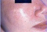 Solar lentigines/freckles