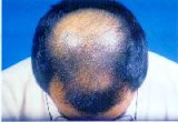 Male pattern baldness