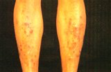 Thin brown scars of diabetic dermopathy