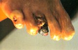 Gangrenous toe as a result of tissue death