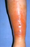 Cellulitis, often resulting from entry of bacterial into the skin from trauma