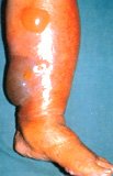 Necrotising fasciitis. A serious, life- threatening infection presenting as inflammed, haemorrhagic swelling and blistering