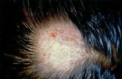 Fungal Infection (Ringworm, Tinea Capitis)