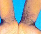 Figure 2 Atopic Dermatitis involving the wrists.