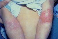 Figure 3 Atopic dermatitis involving the elbow creases.