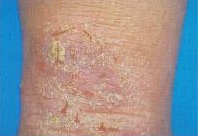 Figure 4 Atopic dermatitis involving the back of the knee