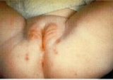 Fig.8 Napkin Dermatitis Ulcers