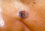 Fig.3 Basal cell carcinoma
