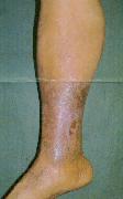 Fig.6 Stasis dermatitis