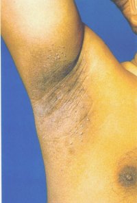 Acanthosis Nigricans (AN)