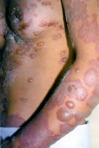 Fig.2 Blistering Skin Disorders