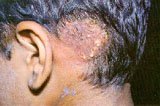 Fig.2 Fungal infection of the scalp with associated hair loss.