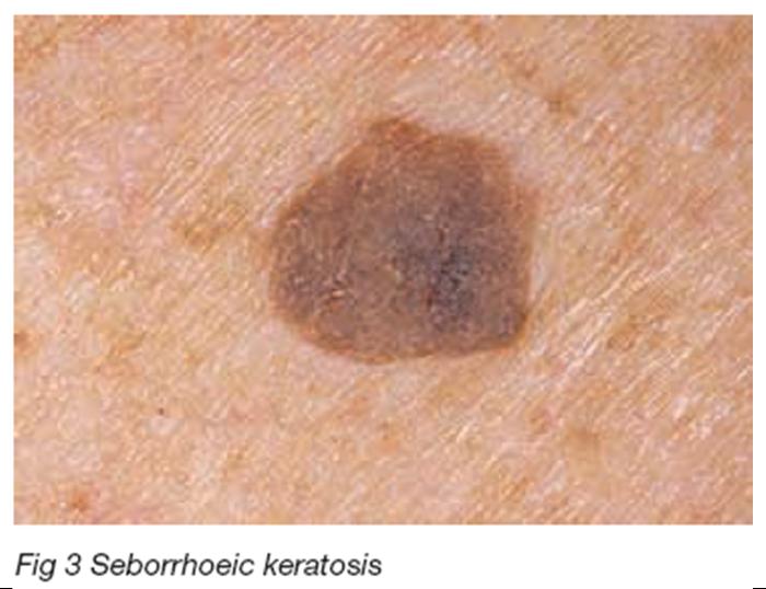 Seborrhoeic keratosis (seborrhoeic warts)