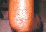 Allergic contact dermatitis to plaster
