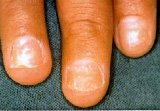 Fungal infection of the nail