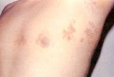 Herpes Zoster (Shingles) - red patches and blisters appear in a band on one side of the body