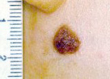 Intradermal melanocytic naevus