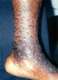 Fig.2 Asteatotic eczema